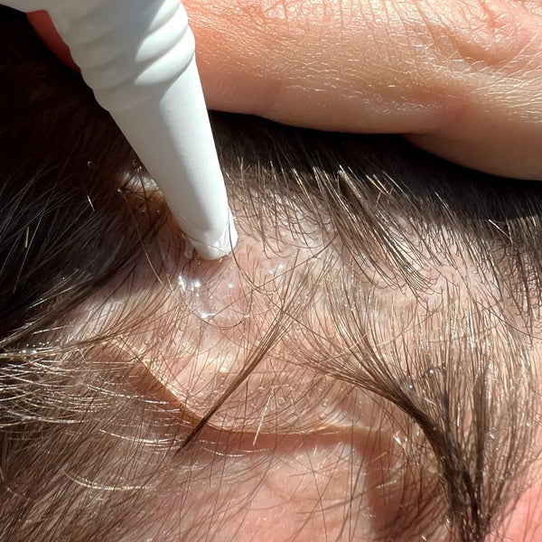 What nobody tells you about a thinning hairline