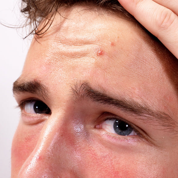 Adult Acne in Men