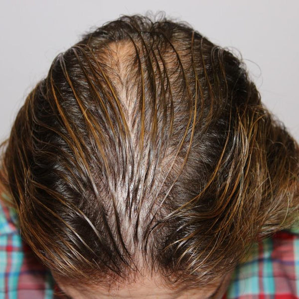 Hair Loss in Men: Early Signs, Real Causes, and What Actually Works