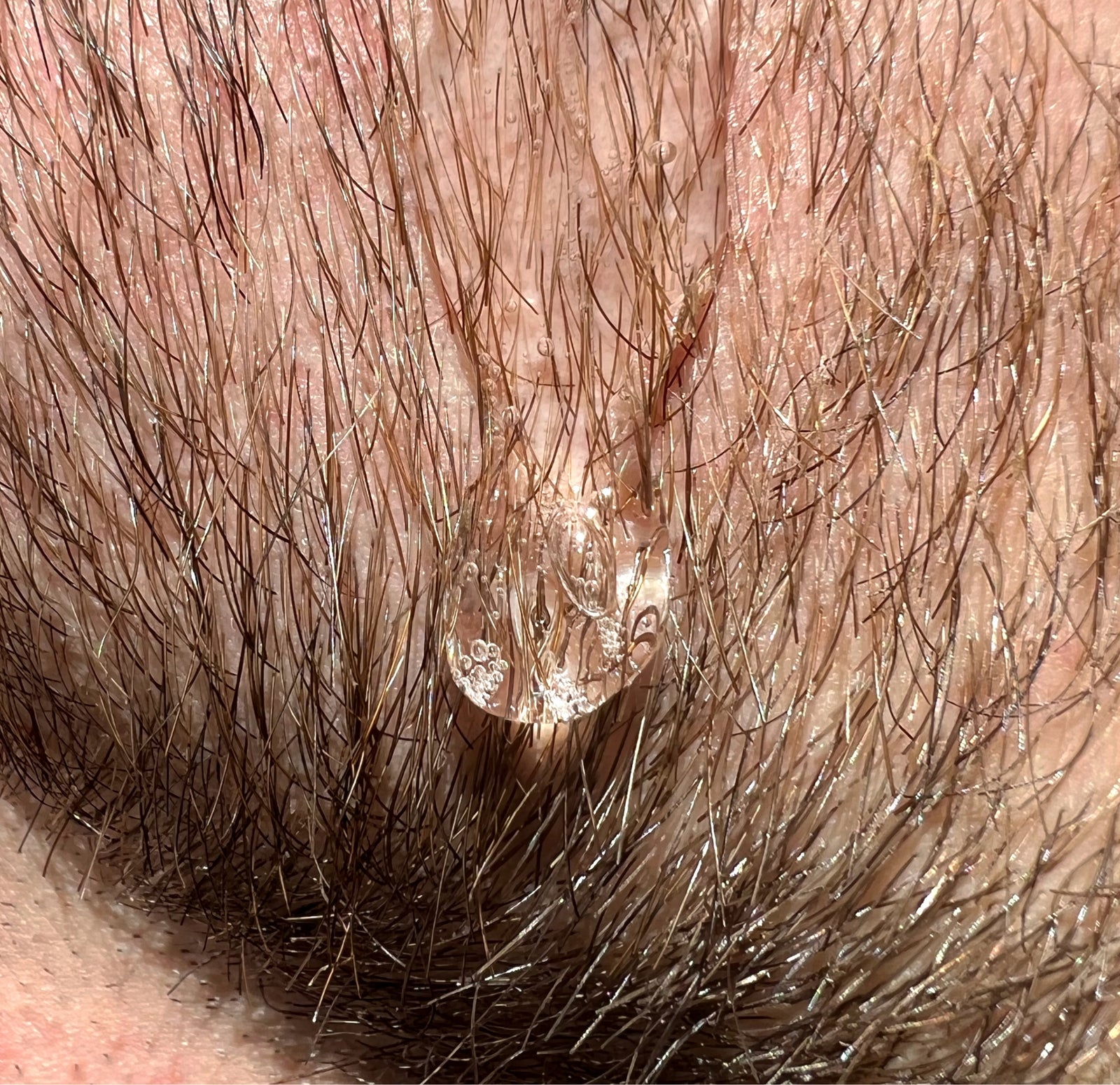 Macro close-up of beard hair follicles